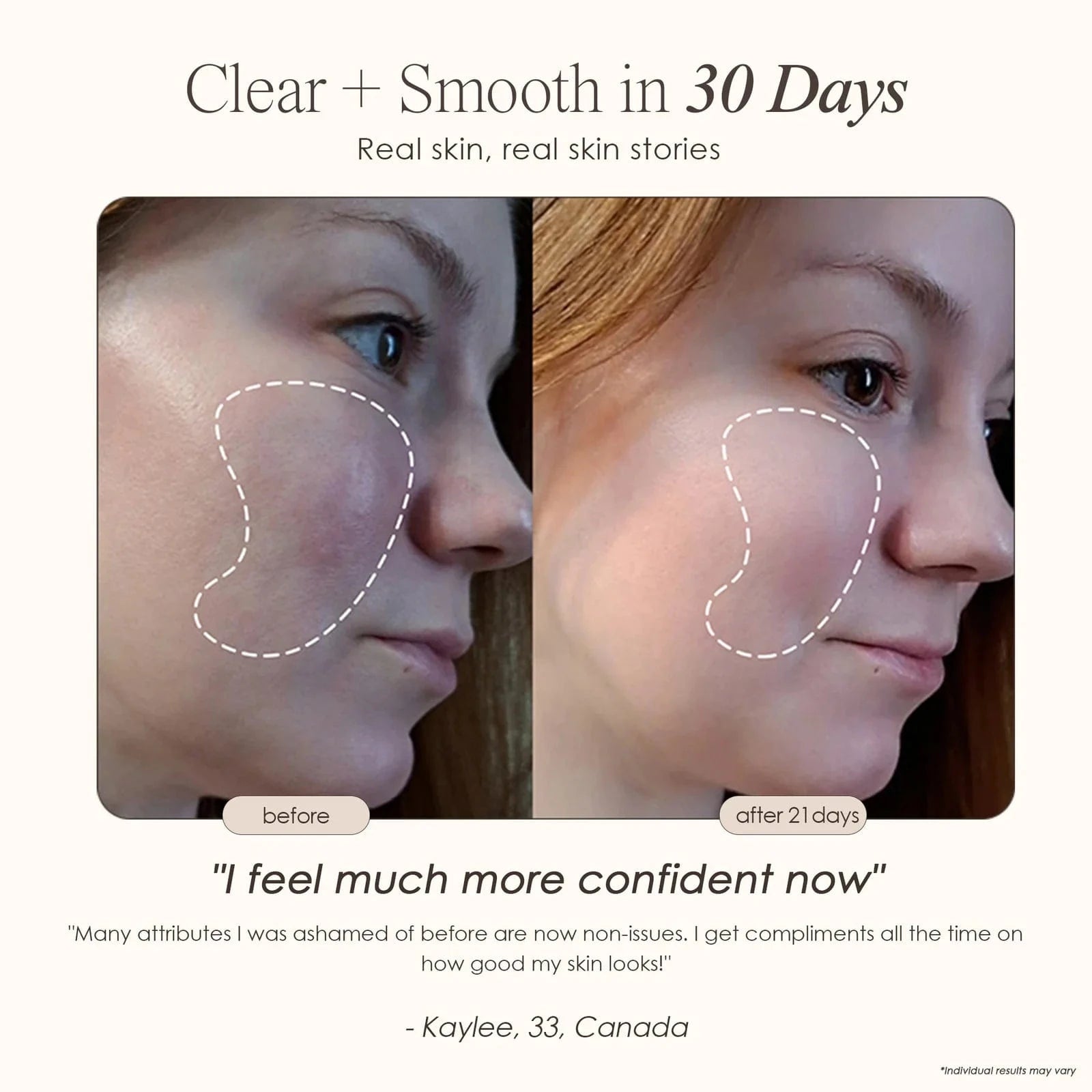 Project E Beauty Skin Care Faisca Neon & Argon | High Frequency Wand